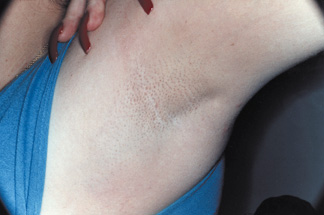Axila depois do Tend Skin — pelos encravados eliminados e pele lisa